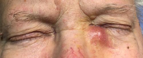 Dacryocystitis - the inftammation of the lacrimal sac